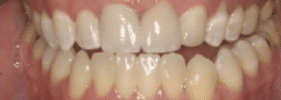 Orthodontic Whitening - After Treatment
