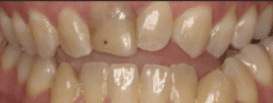 Dental Veneer - Before Treatment