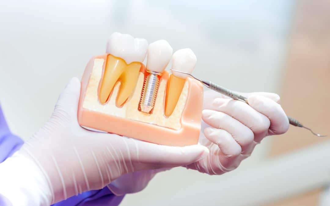 Dental Implant Placement